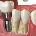 Все, что нужно знать об имплантации зубов «под ключ» в Первоуральске